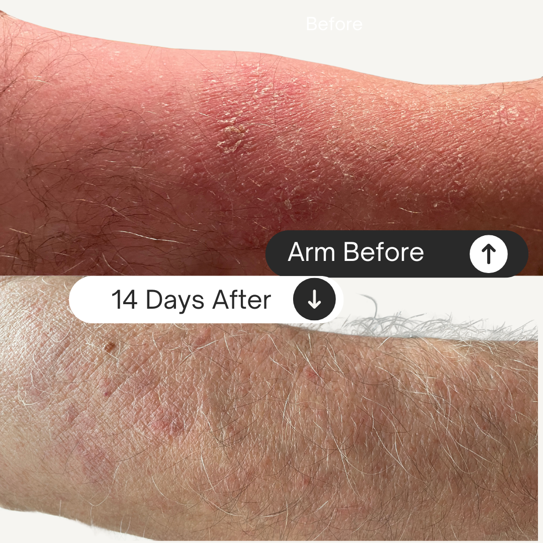 before and after using probiotic cream alive4real with aloe vera.reduce redness and itchiness in 14 days