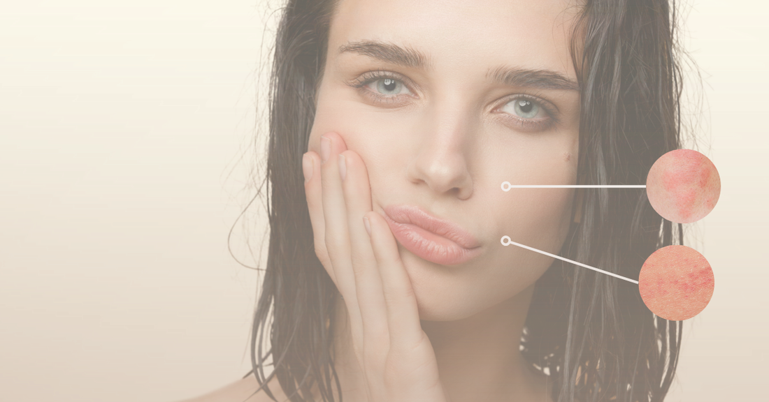 First Impression Prep: How to Reduce Facial Redness in 24 Hours