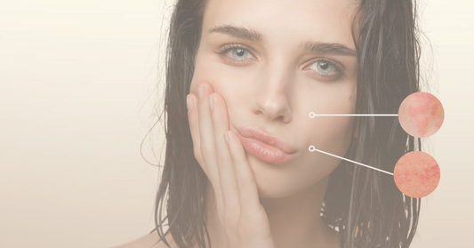 First Impression Prep: How to Reduce Facial Redness in 24 Hours